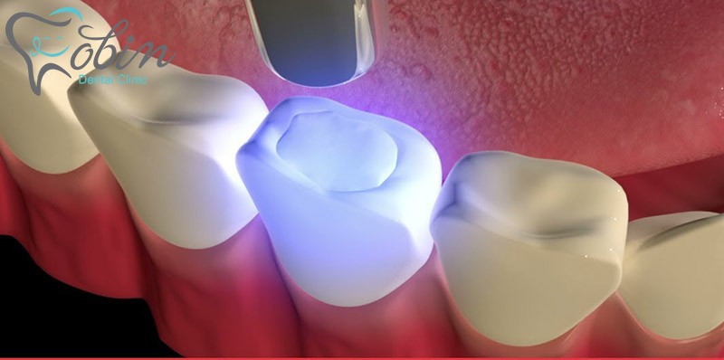 طبقه بندی انواع کامپوزیت دندان بر اساس فرم انتشار